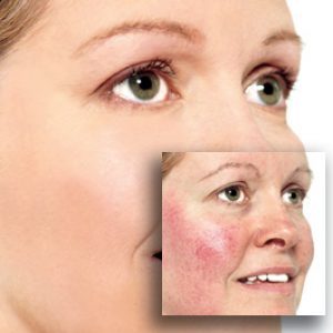 Reverta rosacea creme vermindert blozen en roodheid