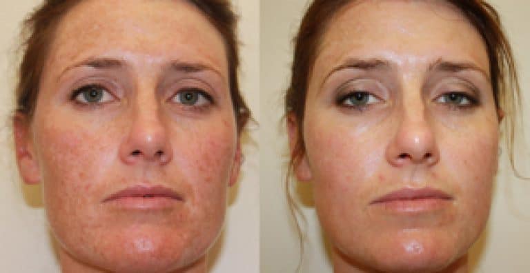 Reverta rosacea creme vermindert beschadigingen van de huid