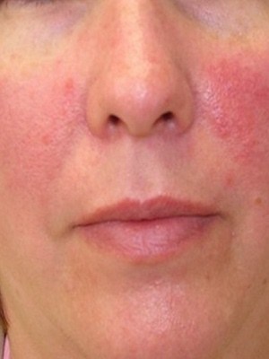 Rosacea creme van Reverta verlicht rosacea op het gezicht