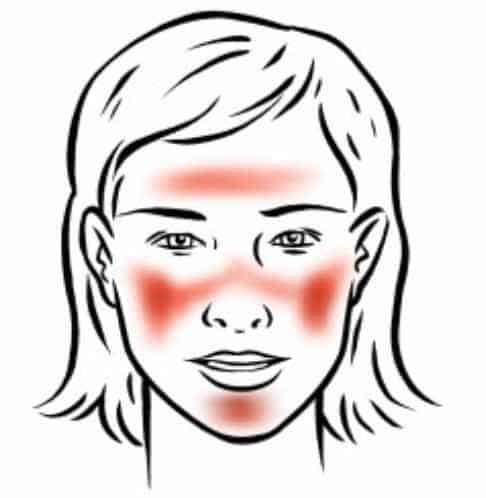 vrouw heeft rosacea creme nodig